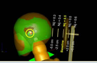 Figure two displays the MADYMO simulation model head and wheelchair-mounted headrest. Five headrest positions are displayed with corresponding neck injury criteria vales. Headrest positions are varied in the fore-aft direction. Headrest positions closest to the head are smallest; those further away are greatest. 